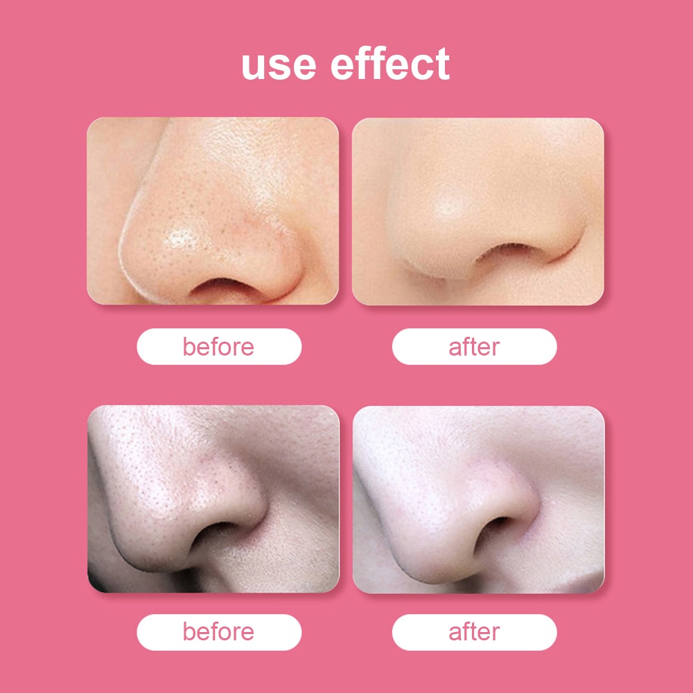 Electric Acne Blackhead Remover Vacuum Suction Extractor Tool Nano Facial Sprayer Steamer Humidifier Pore Cleaner Skin Care Tool