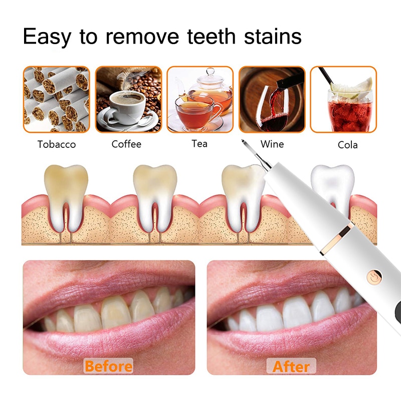 Electric Sonic Dental Calculus Scaler Oral Teeth Tartar Remover Plaque Stains Cleaner Removal Teeth Whitening Portable with LED