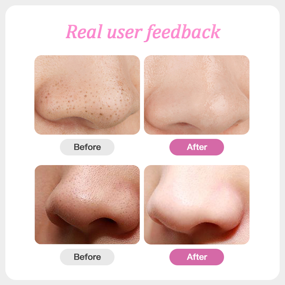 New Facial Blackhead Remover