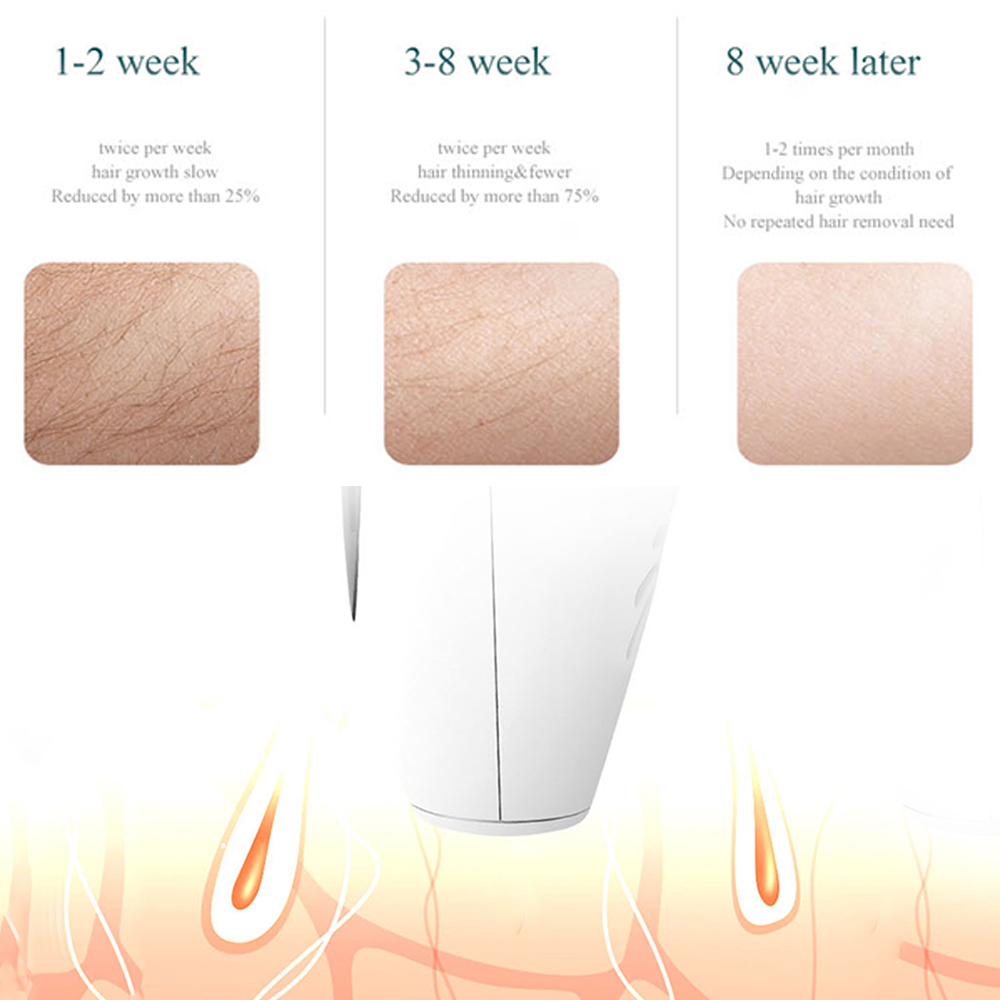 IPL Laser