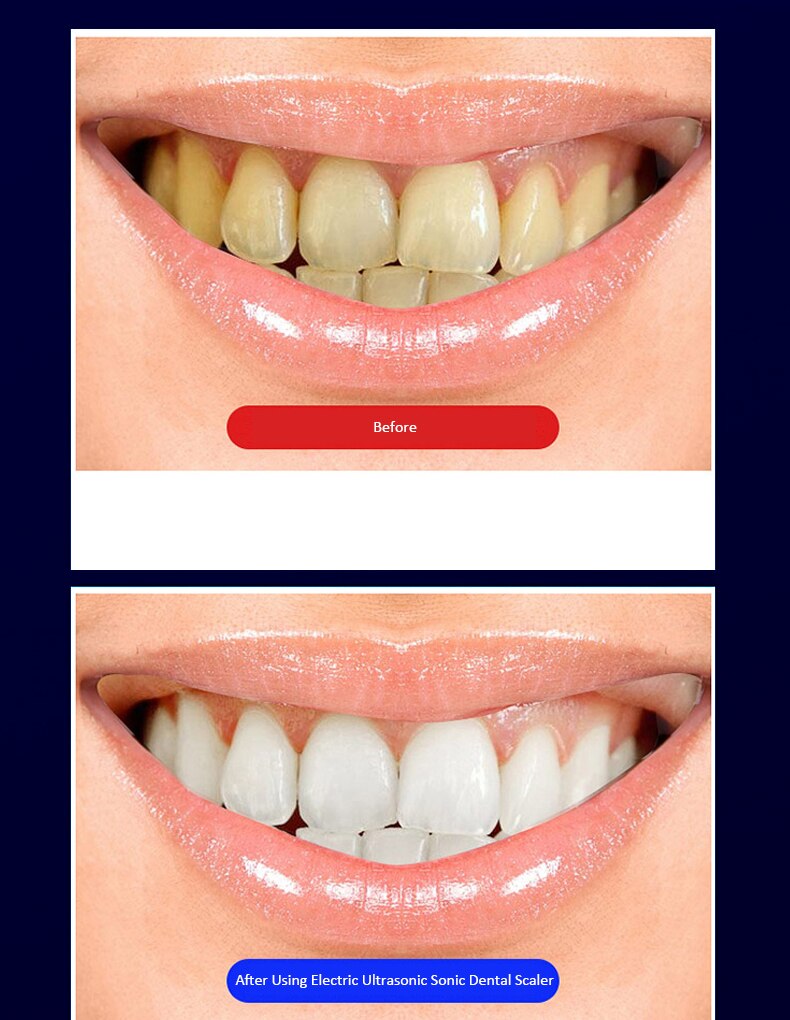 Usb Recharge Dental Scale