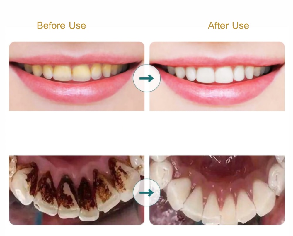 Dental Calculus Remover