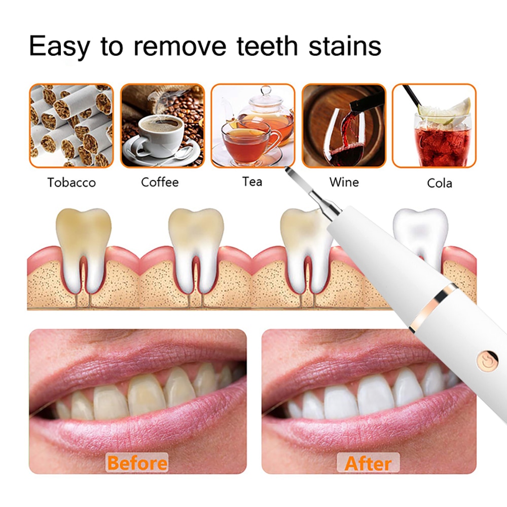 Dental Calculus Remover 